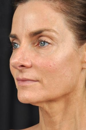 Laser Skin Rejuvenation