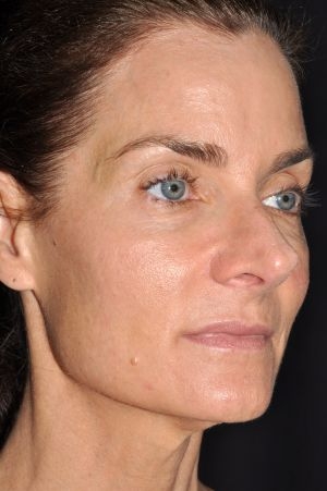 Laser Skin Rejuvenation