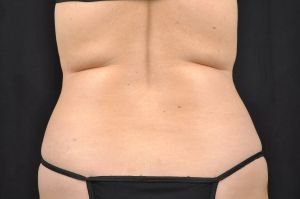 CoolSculpting