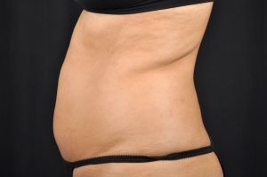 CoolSculpting