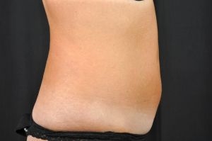 CoolSculpting