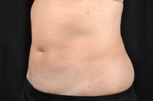 CoolSculpting