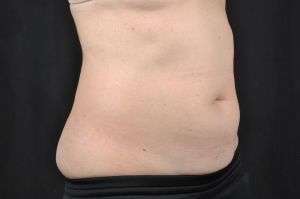 CoolSculpting