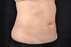 CoolSculpting