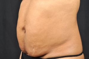 CoolSculpting