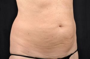 CoolSculpting