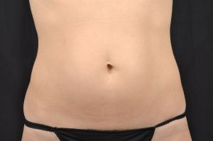 CoolSculpting