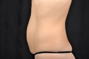 CoolSculpting