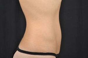 CoolSculpting